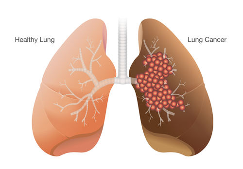 lung_Cancer 